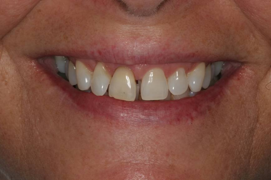 Before dental treatment - Case 2