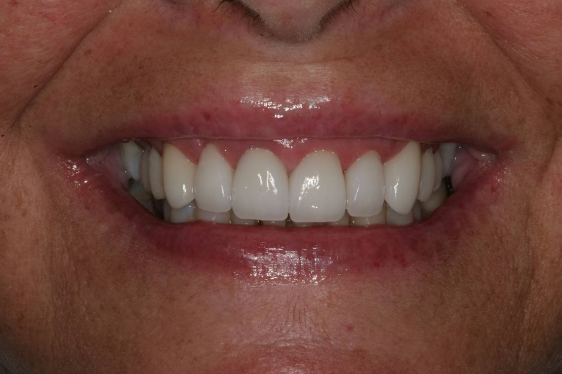 After dental treatment - Case 2