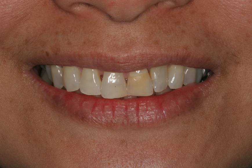 Before dental treatment - Case 3