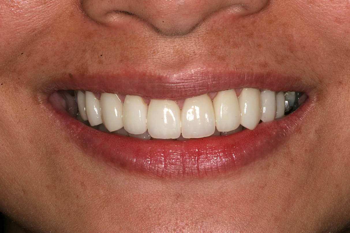 After dental treatment - Case 3