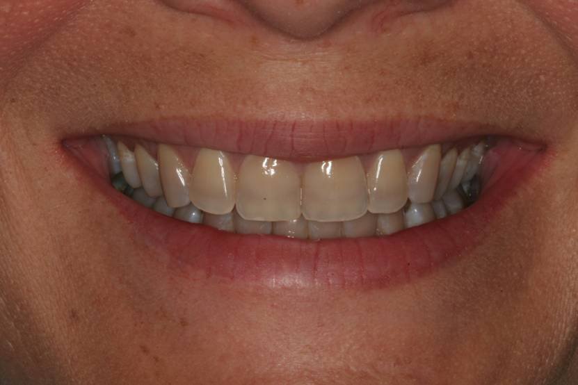 Before dental treatment - Case 4