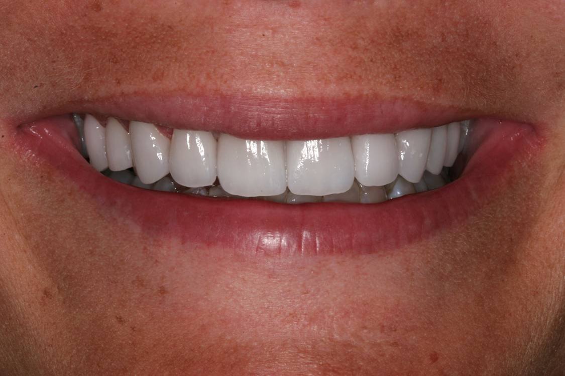 After dental treatment - Case 4