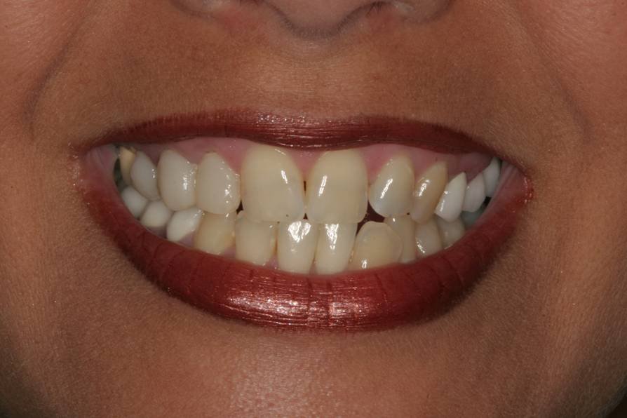 Before dental treatment - Case 5