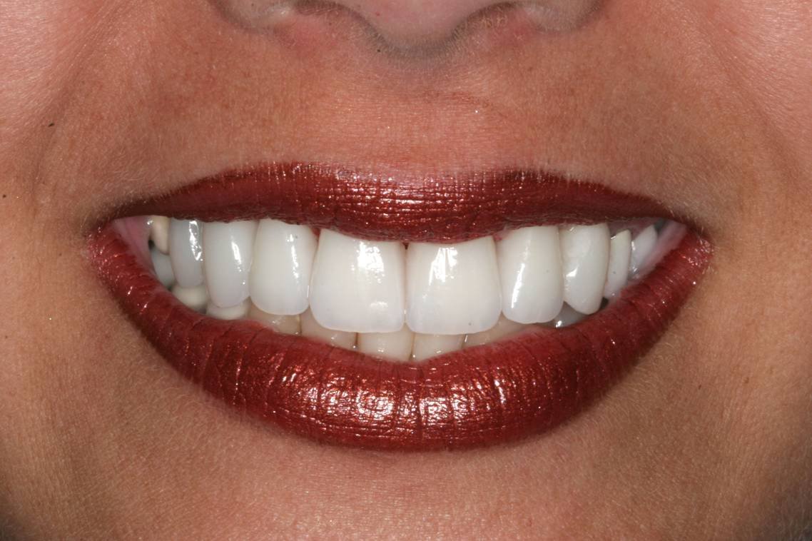 After dental treatment - Case 5